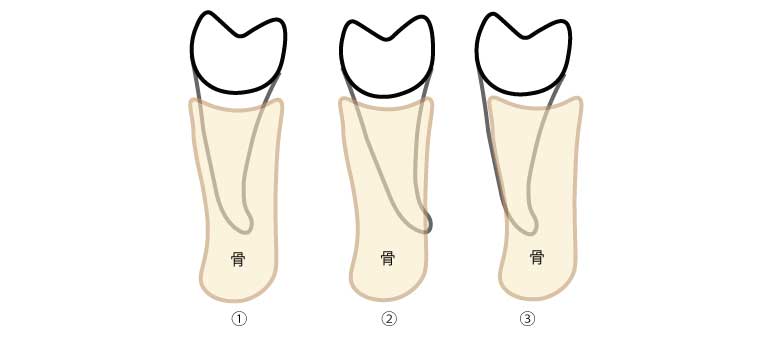 歯が骨に埋まっている状態の断面図