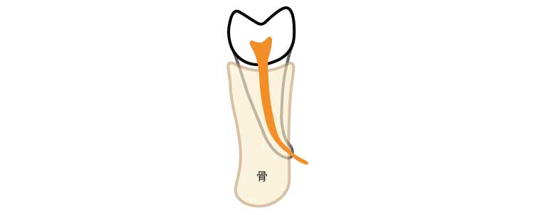 根の先端が骨から出てしまうと