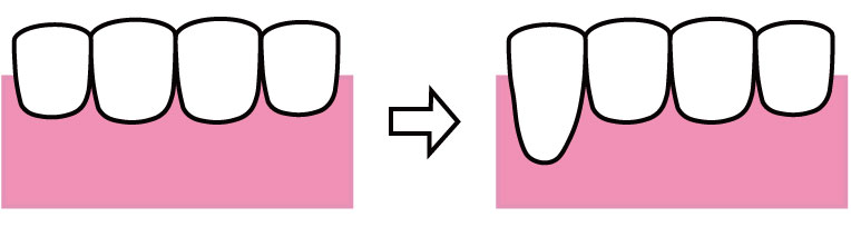 骨から歯がはみ出る