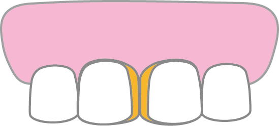 すきっ歯Bのイメージ