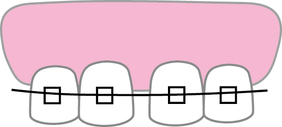 すきっ歯Gのイメージ