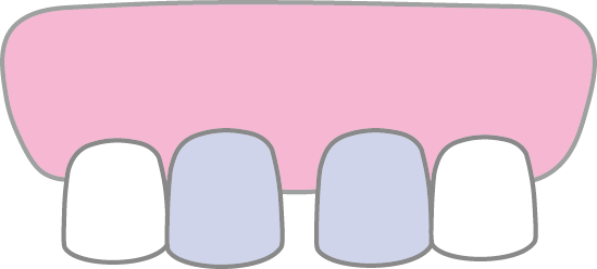 すきっ歯Jのイメージ